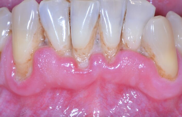 Avant traitement initial - Parodontite modérée avec dysharmonie dentaire primitive chez patient non fumeur