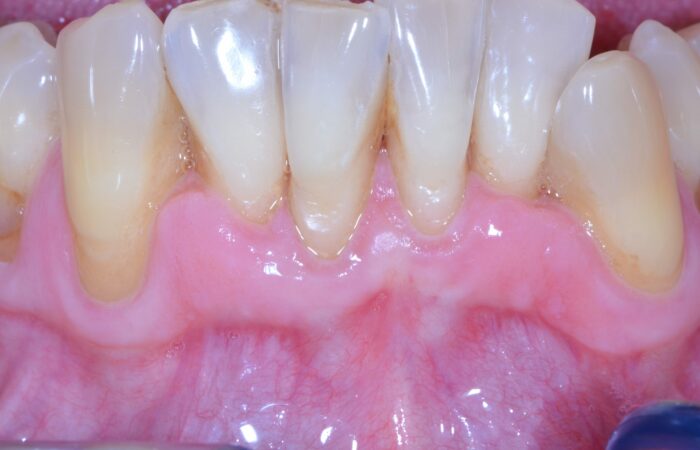 Après traitement initial - Parodontite modérée avec dysharmonie dentaire primitive chez patient non fumeur