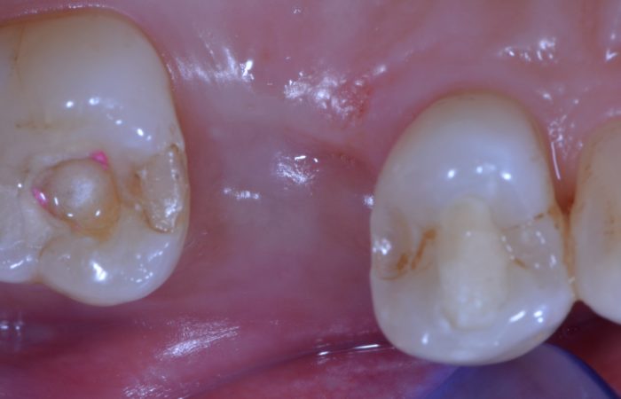 #15: dent extraite suite à fracture