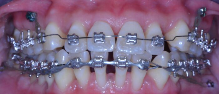 Mini-vis d'ancrage orthodontique