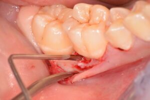Traitement d'une lésion parodontale infraosseuse - peropératoire